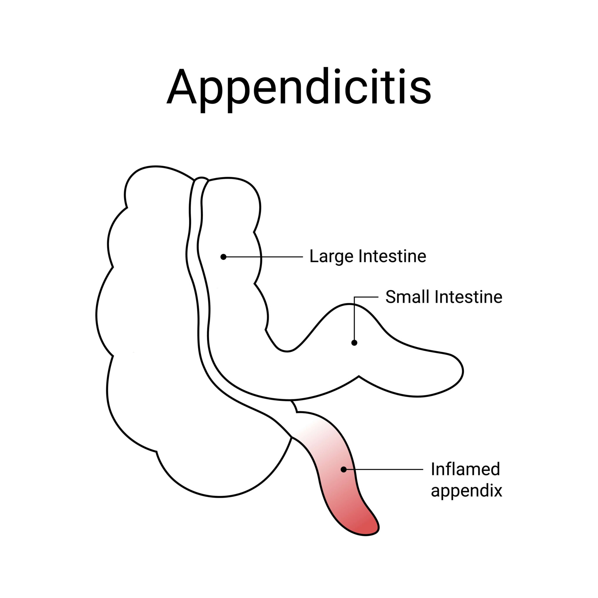 Upala slijepog crijeva apendicitis uzroci simptomi i liječenje