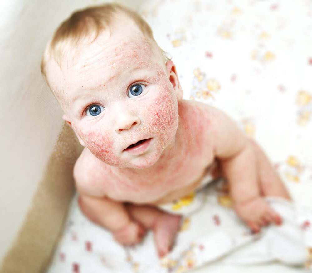 Atopijski dermatitis kod beba