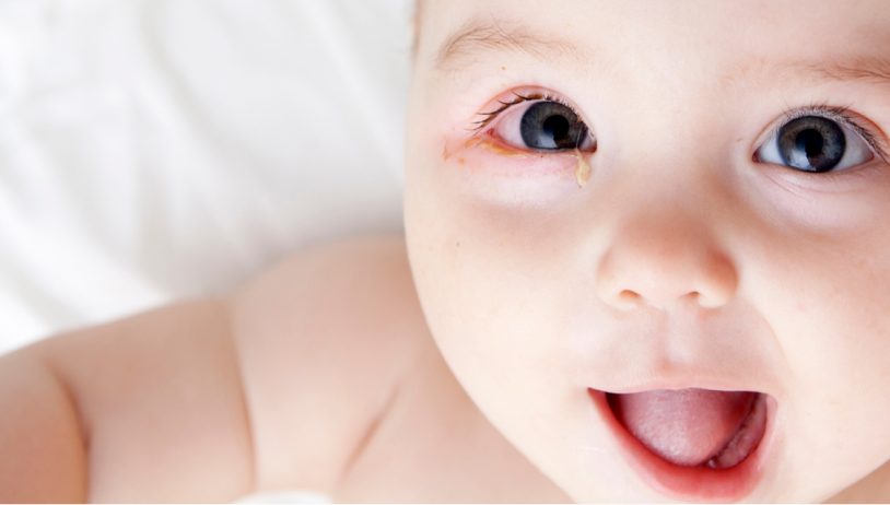 Konjuktivitis kod beba i djece