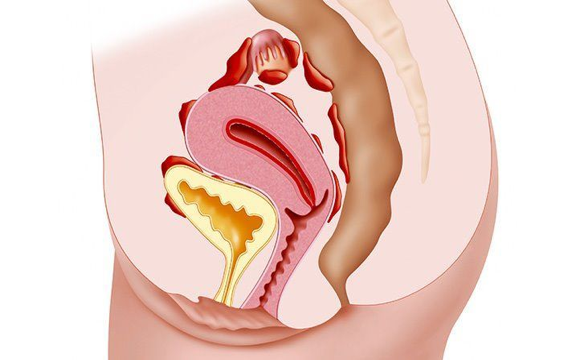 endometrioza crijeva
