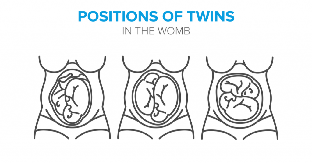 blizanci trudnoća