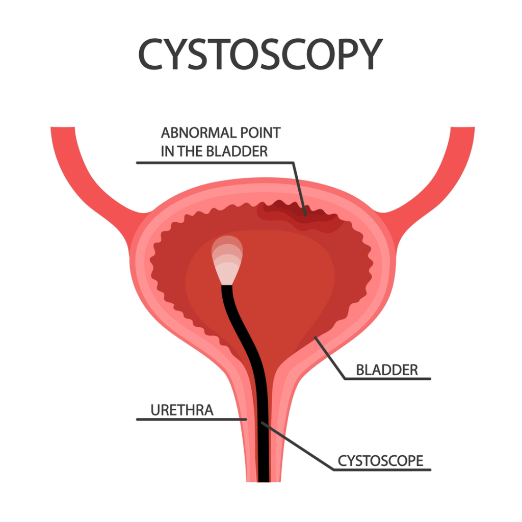 inkontinencija citoskop