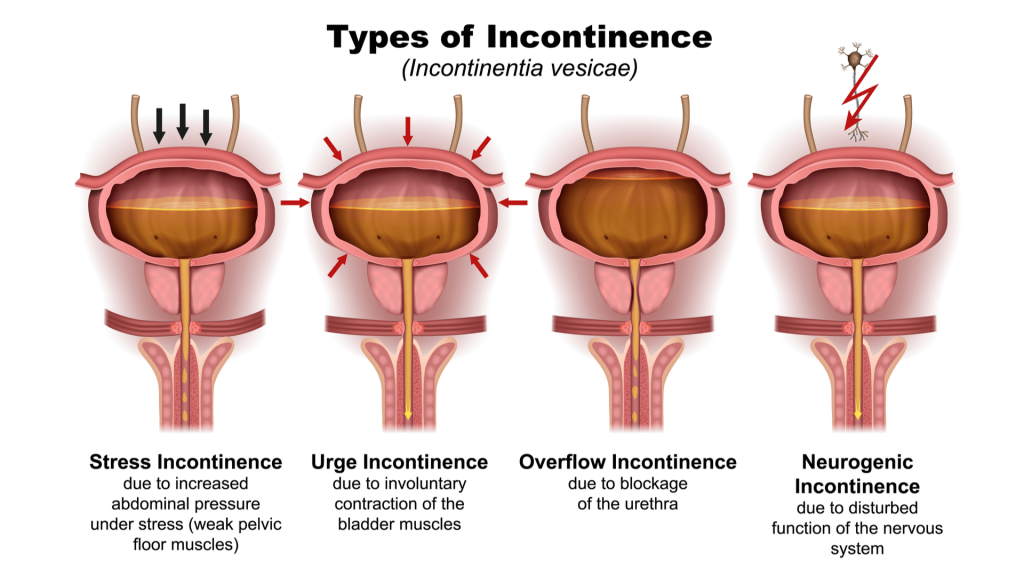 vrste inkontinencije
