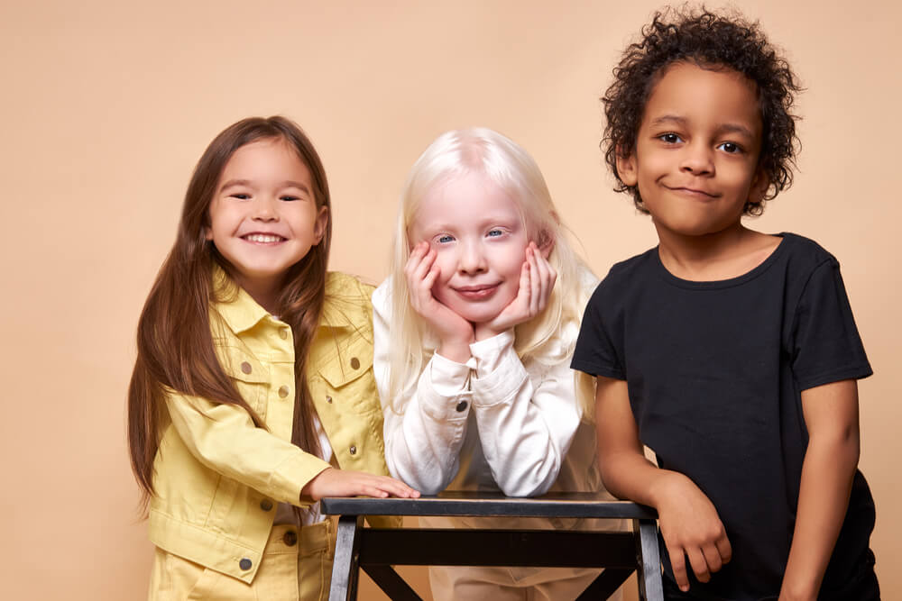 Albinizam - djeca 