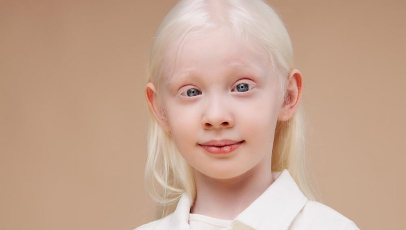 Albinizam — rijedak nasljedni poremećaj