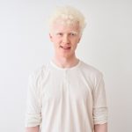 albinizam uzrok