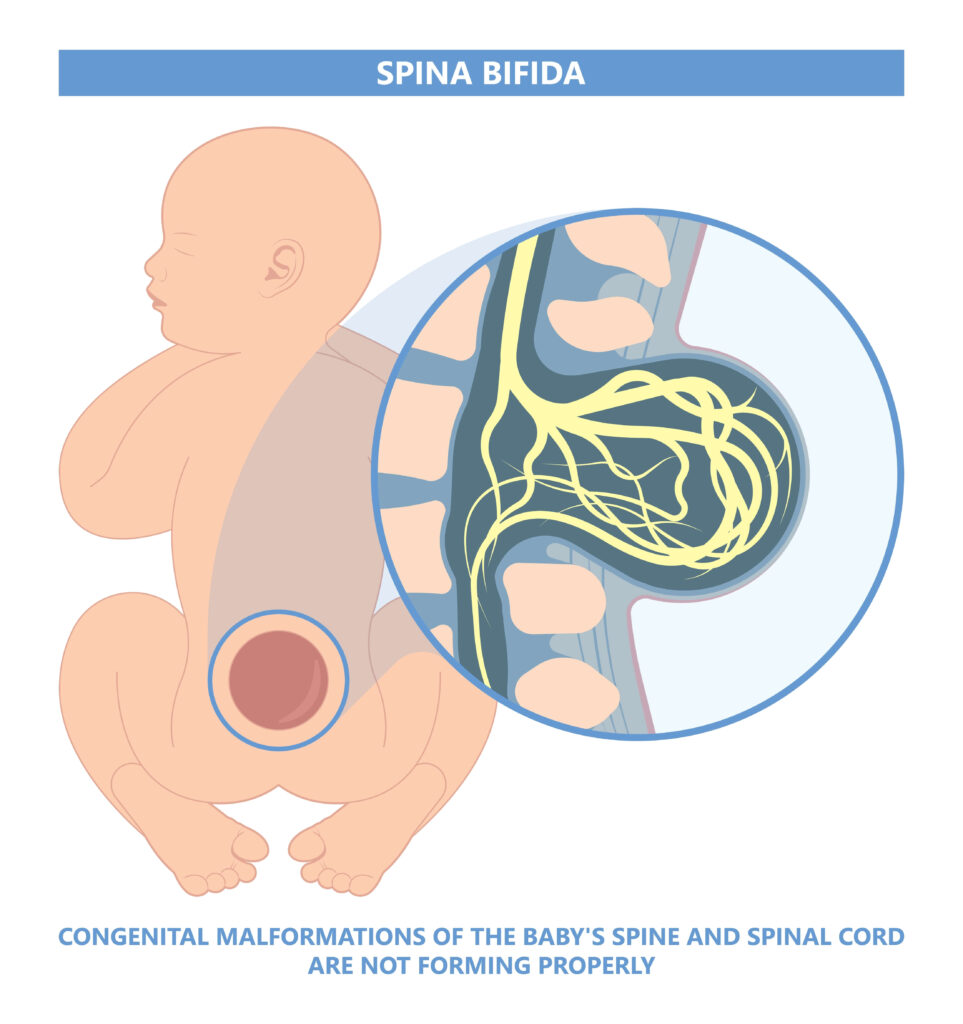 što je spina bifida