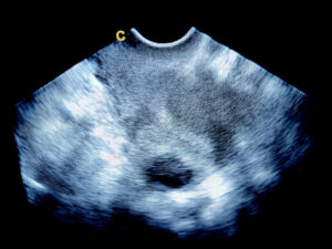 Ultrazvučni prikaz mioma na maternici
