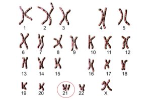 Kromosomi Down Sindrom