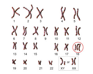 Kromosomi Edwards Sindrom