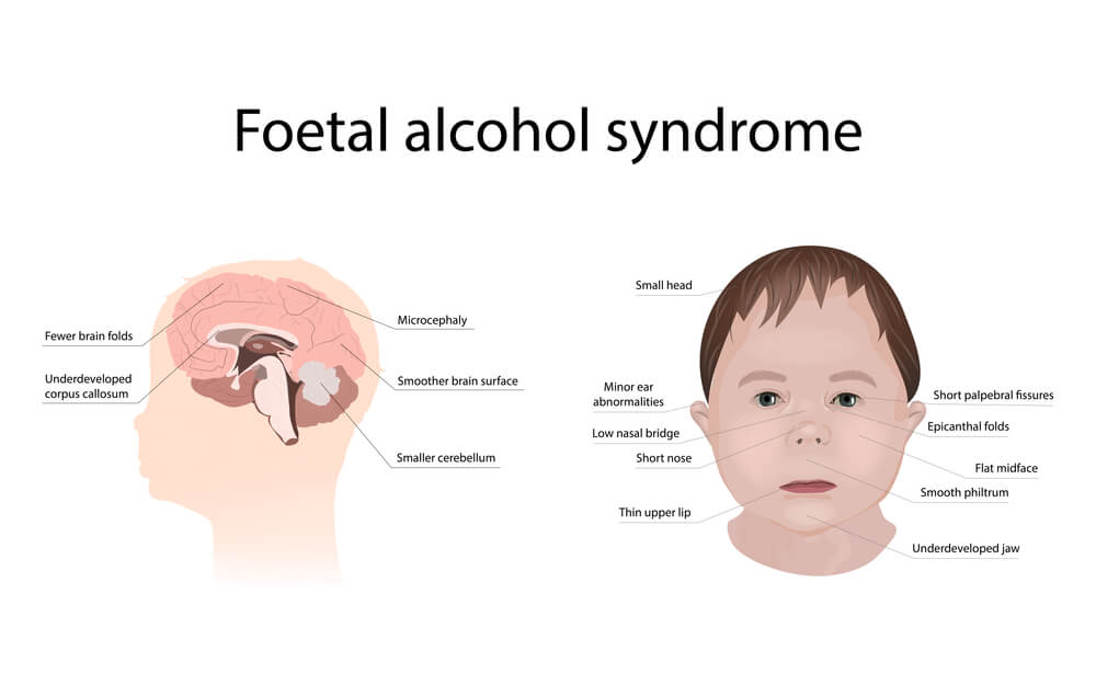 Karakteristike djeteta s fetalnim alkoholnim sindromom