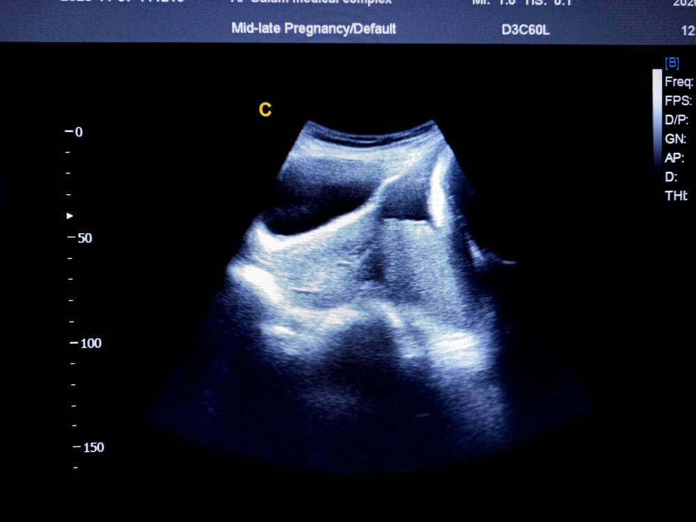 Parcijalna placenta previa