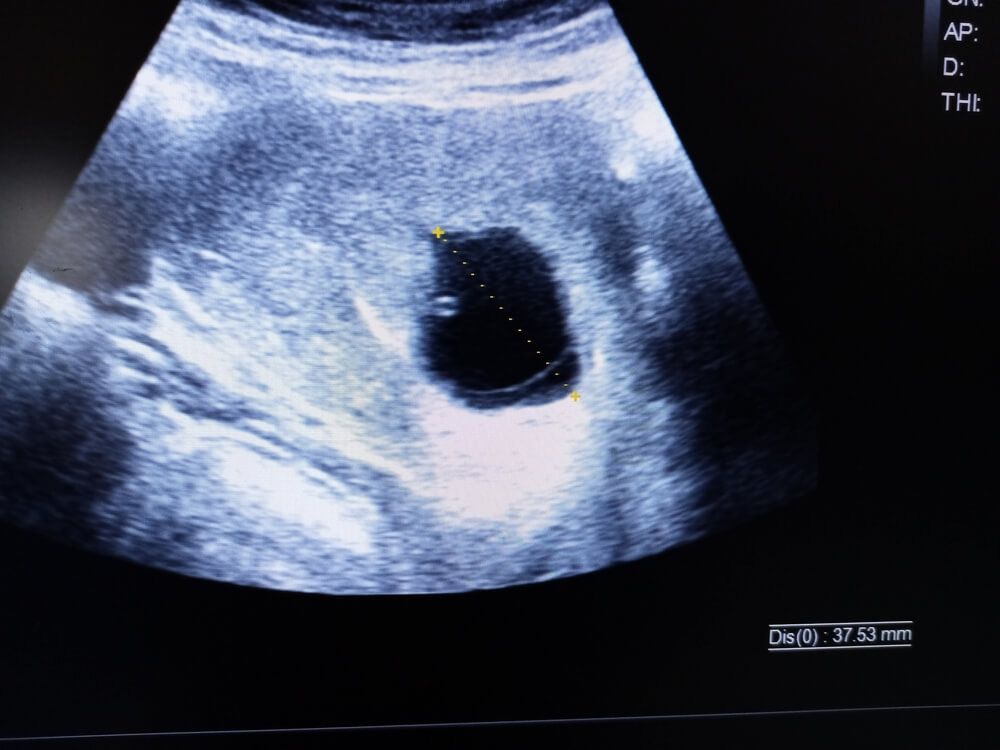 Anembrionalna trudnoća ultrazvuk