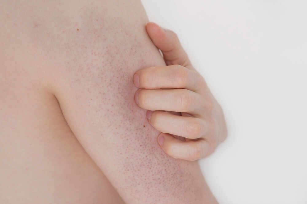 Keratosis pilaris